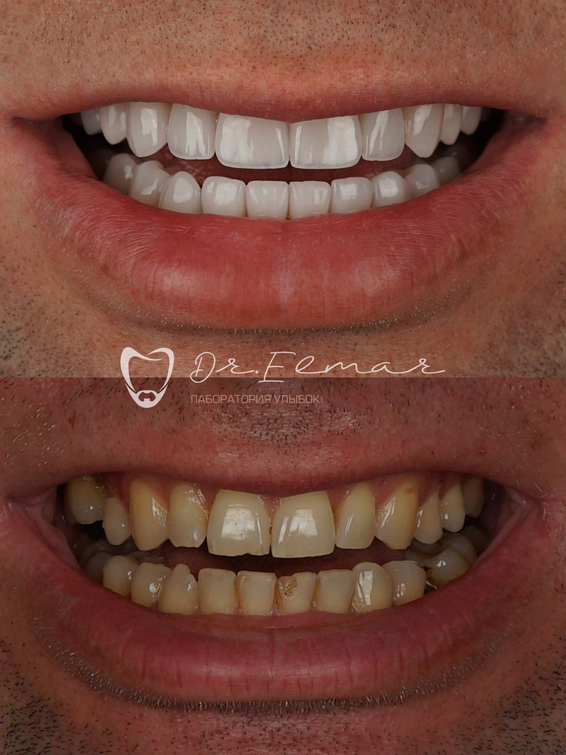 Кейс установки виниров E-max: до и после